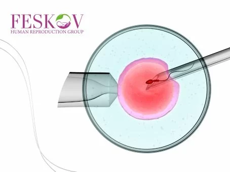 ICSI-Verfahren: Merkmale und Möglichkeiten Bild